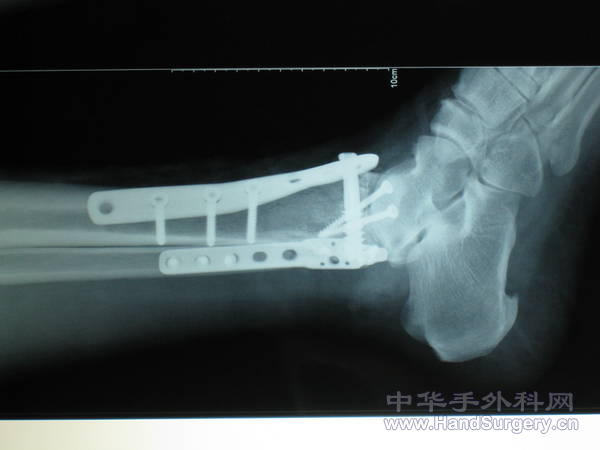 术后x9.jpg