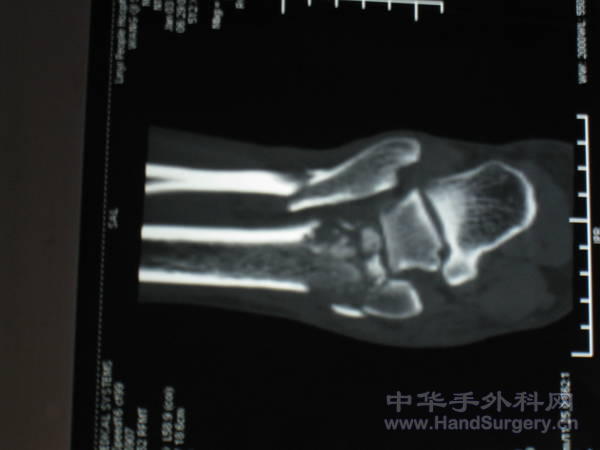 术前ct5.jpg