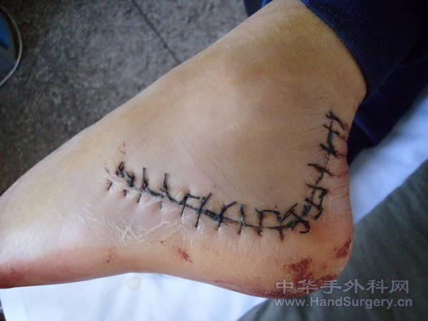 跟骨术后PB140001.JPG