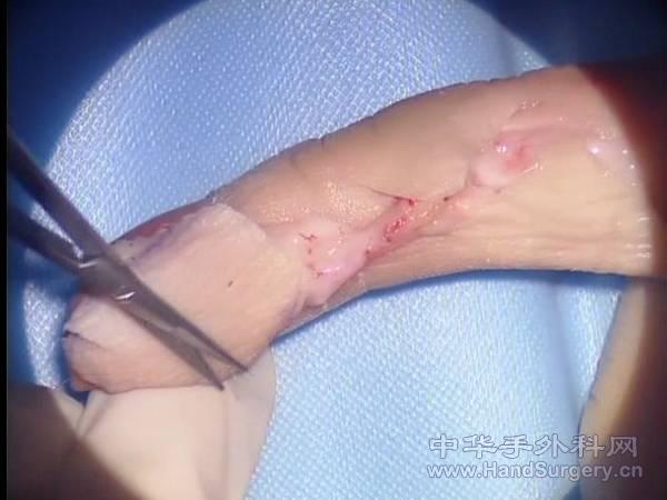 血管链3.jpg