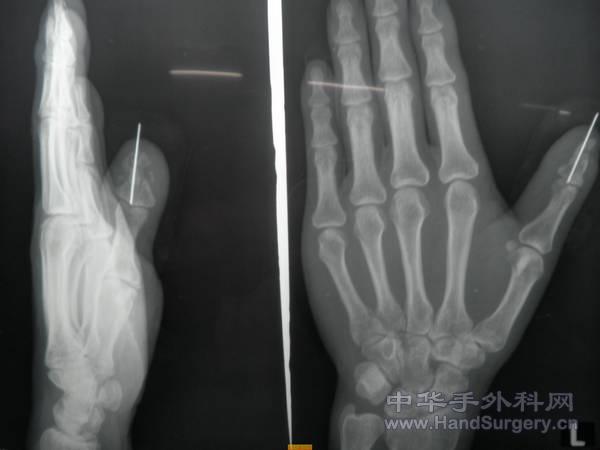 术后1.JPG