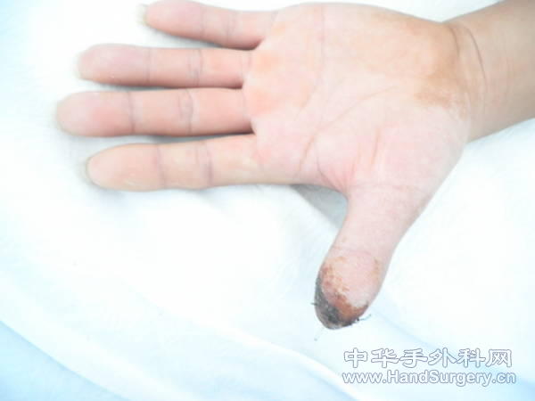 术后2.JPG