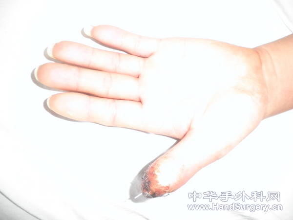 术后3.JPG