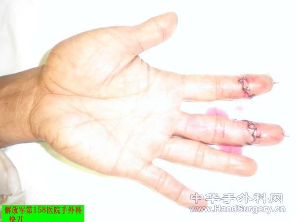 术后2.JPG