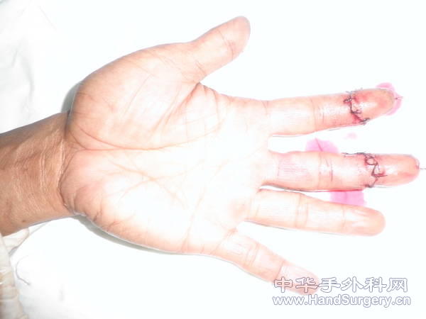 术后3.JPG