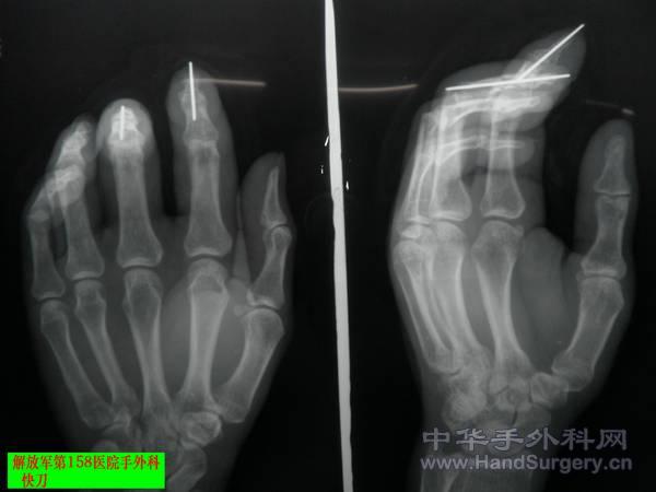 术后4.JPG