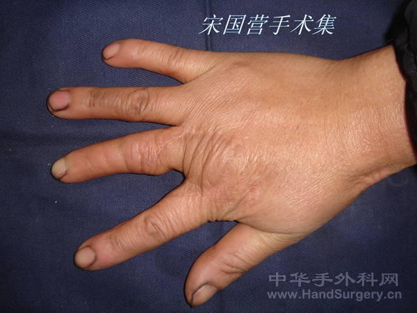术后