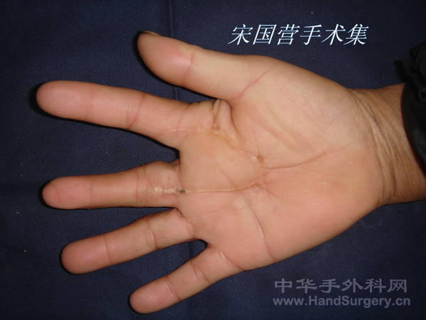 术后