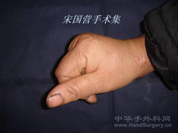 术后