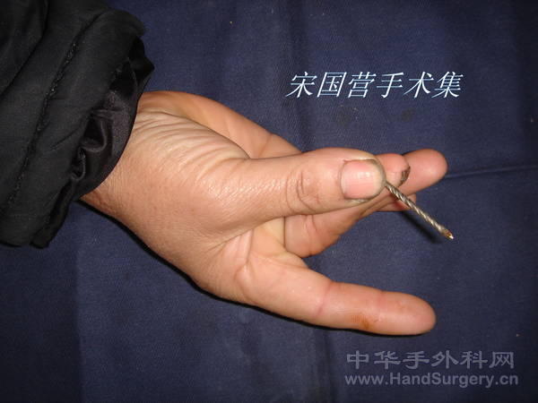 术后