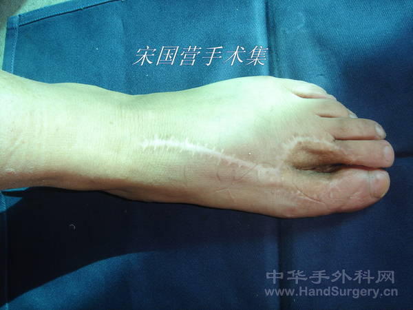 术后