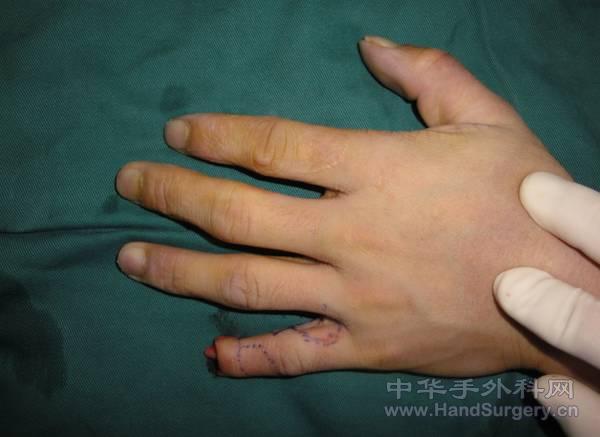 动脉串联皮瓣