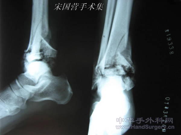术前