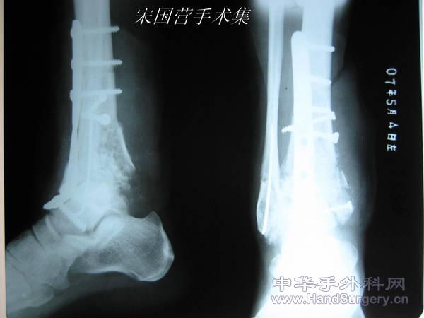 踝关节融户术后