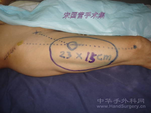 设计皮瓣