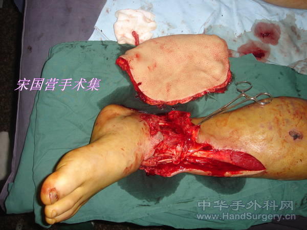游离后