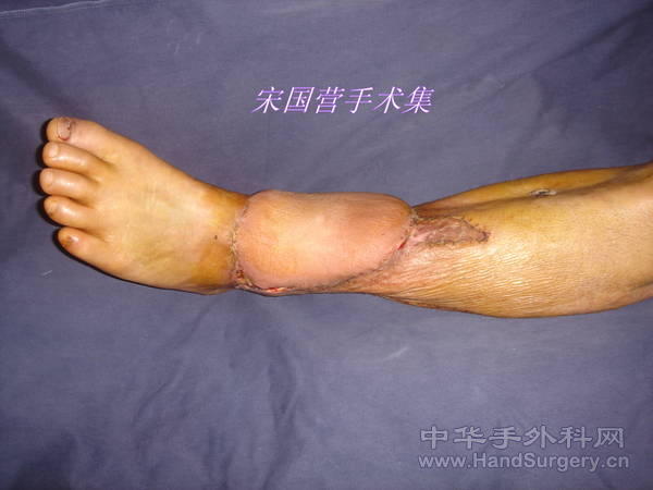 术后成活