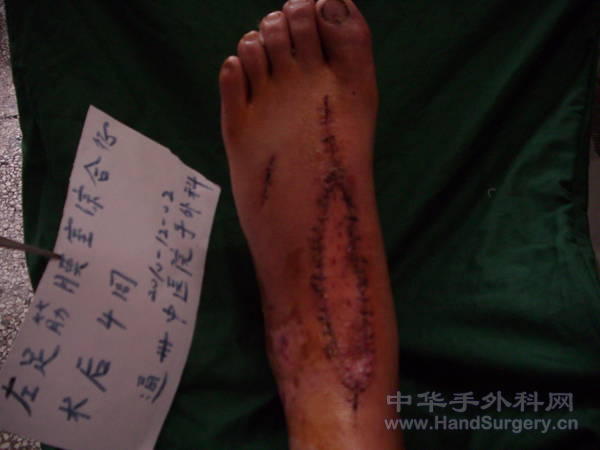 术后4周