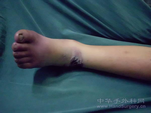 前足麻木、冰凉