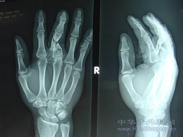 近节指骨粉碎性骨折，骨折块细小