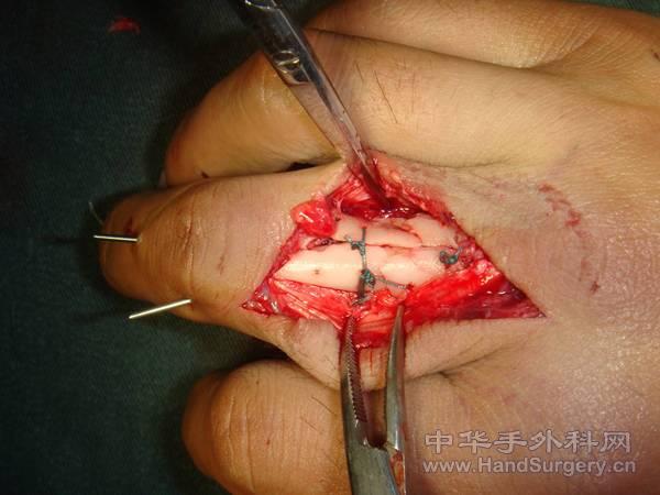 术中用克氏针交叉固定后，将碎小的骨块钻孔后，用无损伤线缝合固定，