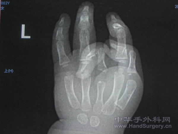 第三掌骨生长不足