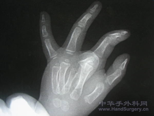 第三掌骨？