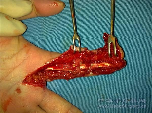 修复了A3A4滑车后的情况