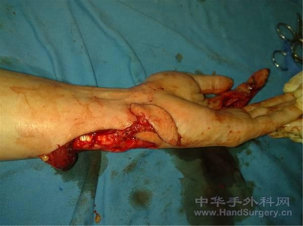 设计尺动脉腕上支皮瓣
