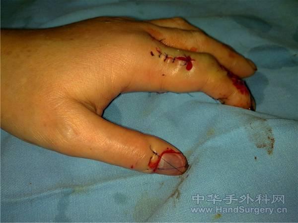 手背清创缝合后情况