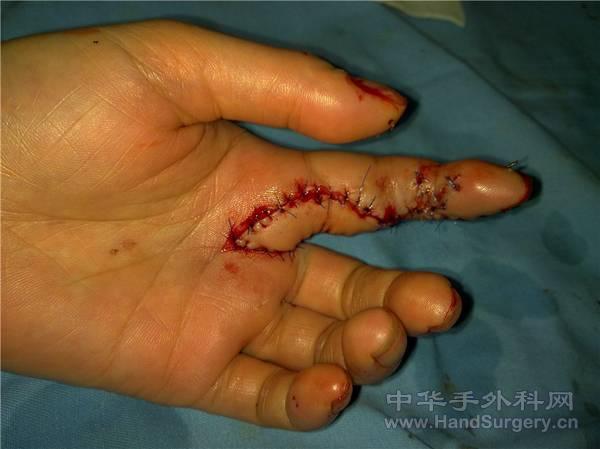 皮瓣修复后情况