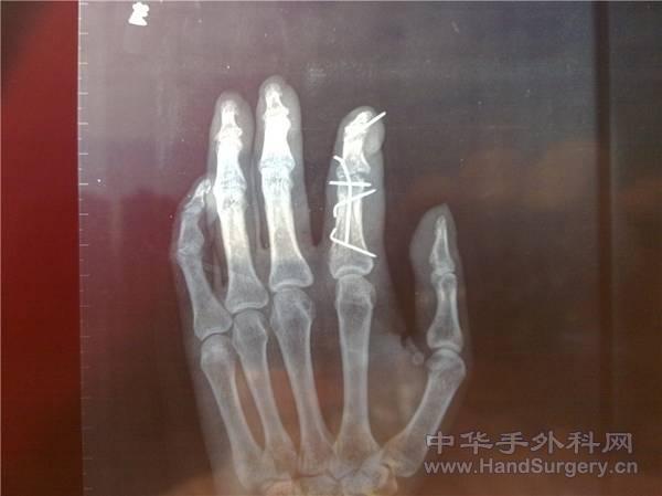 术后骨折X线正位情况