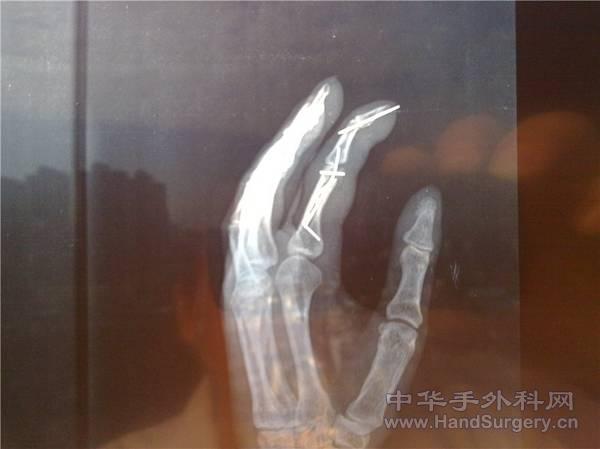 术后骨折X线斜位情况