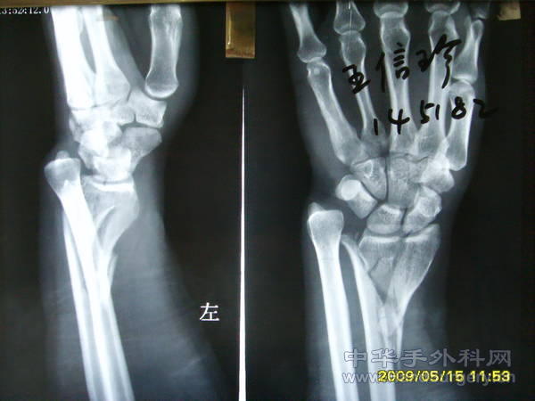 左桡骨远端粉碎性骨折