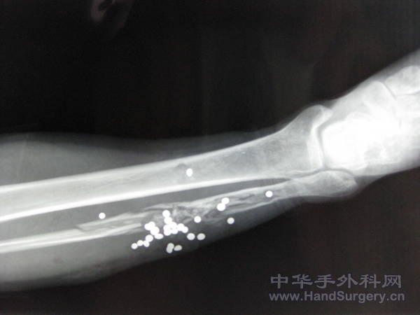 皮肤创面