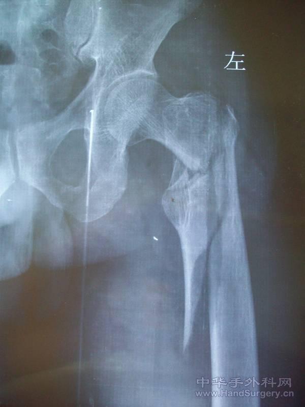 术前