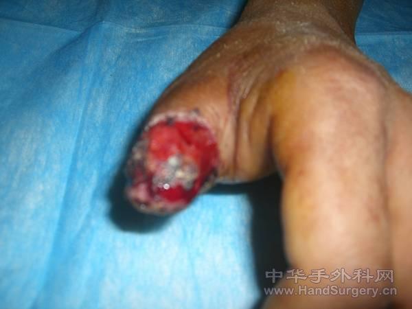 再植拇指坏死经过清创后创面