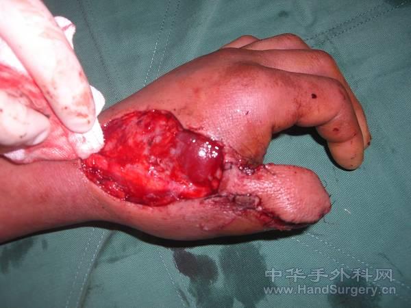 皮瓣转移完成修复创面