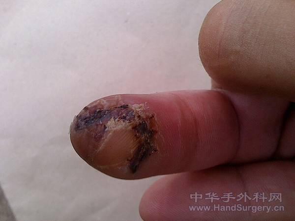 拆线后2.jpg