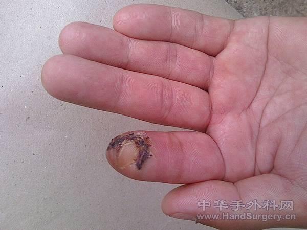 拆线后1.jpg