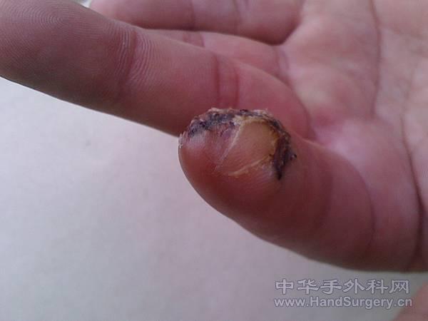 拆线后5.jpg