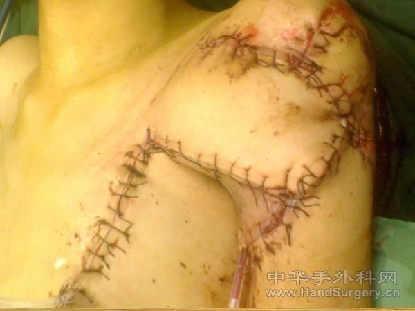 胸大肌皮瓣修复术后