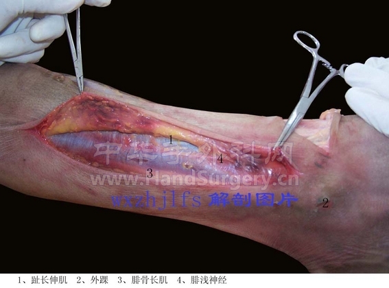 腓动脉穿支后面观1