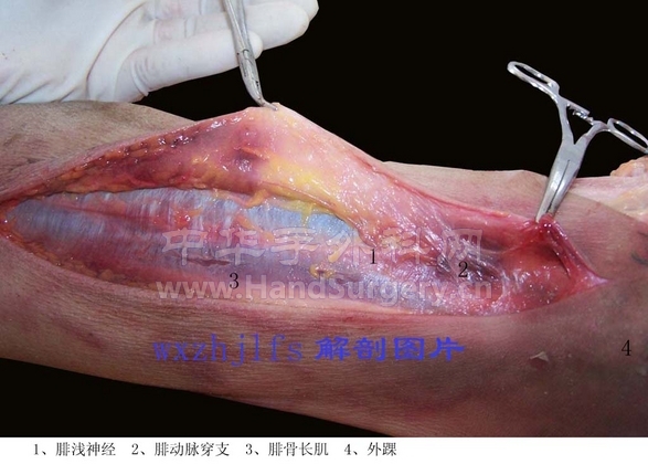 腓动脉穿支后面观2