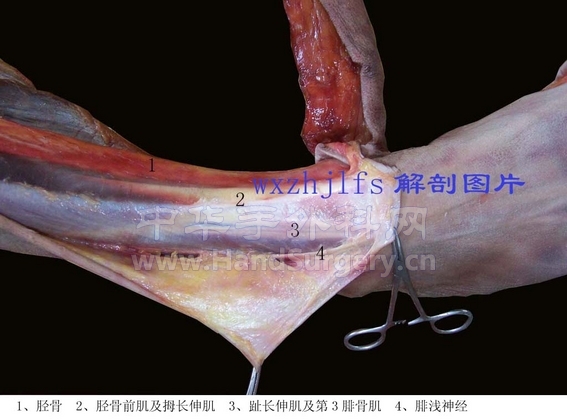 腓动脉穿支前面观