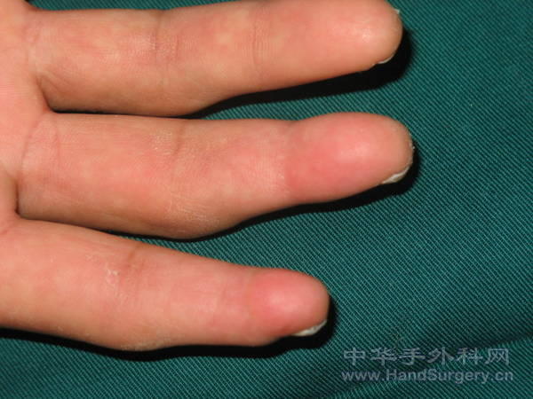 示中指末节离断术后3个月