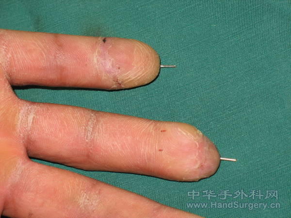 环小指再植术后一月