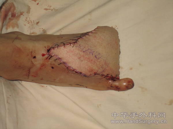 皮瓣通血后