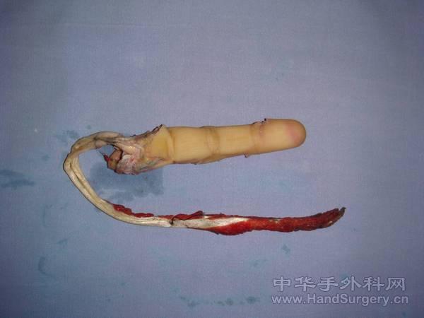 指深、指浅屈肌腱自近端肌腹部抽出，指神经、指动脉自近端抽出