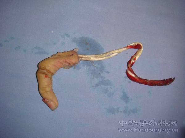 断离指体伸指肌腱自末节撕脱，远近侧指间关节侧副韧带均断裂，关节脱位